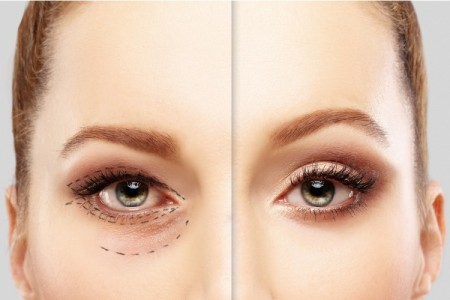 blefaroplastia-antes-depois